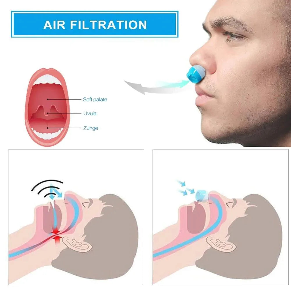 Hoseless, Maskless, Micro-CPAP Anti Snoring