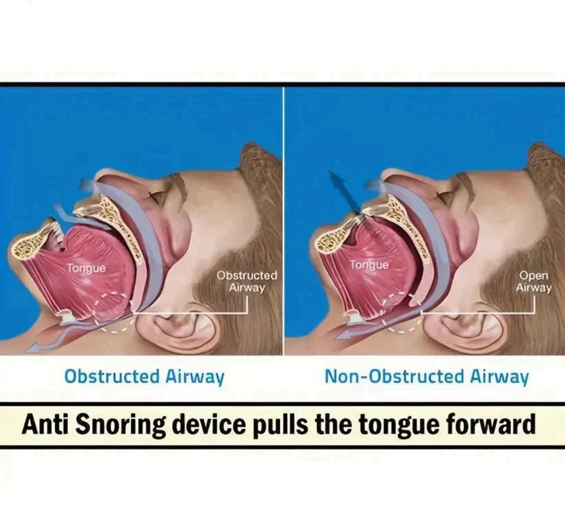 Snore Stop - SleepEase Mouthguard 2024 New Year Hot Sale 70% OFF