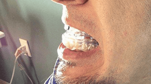 Anti-Snore Mouth Piece – Hot Sale Off 50%