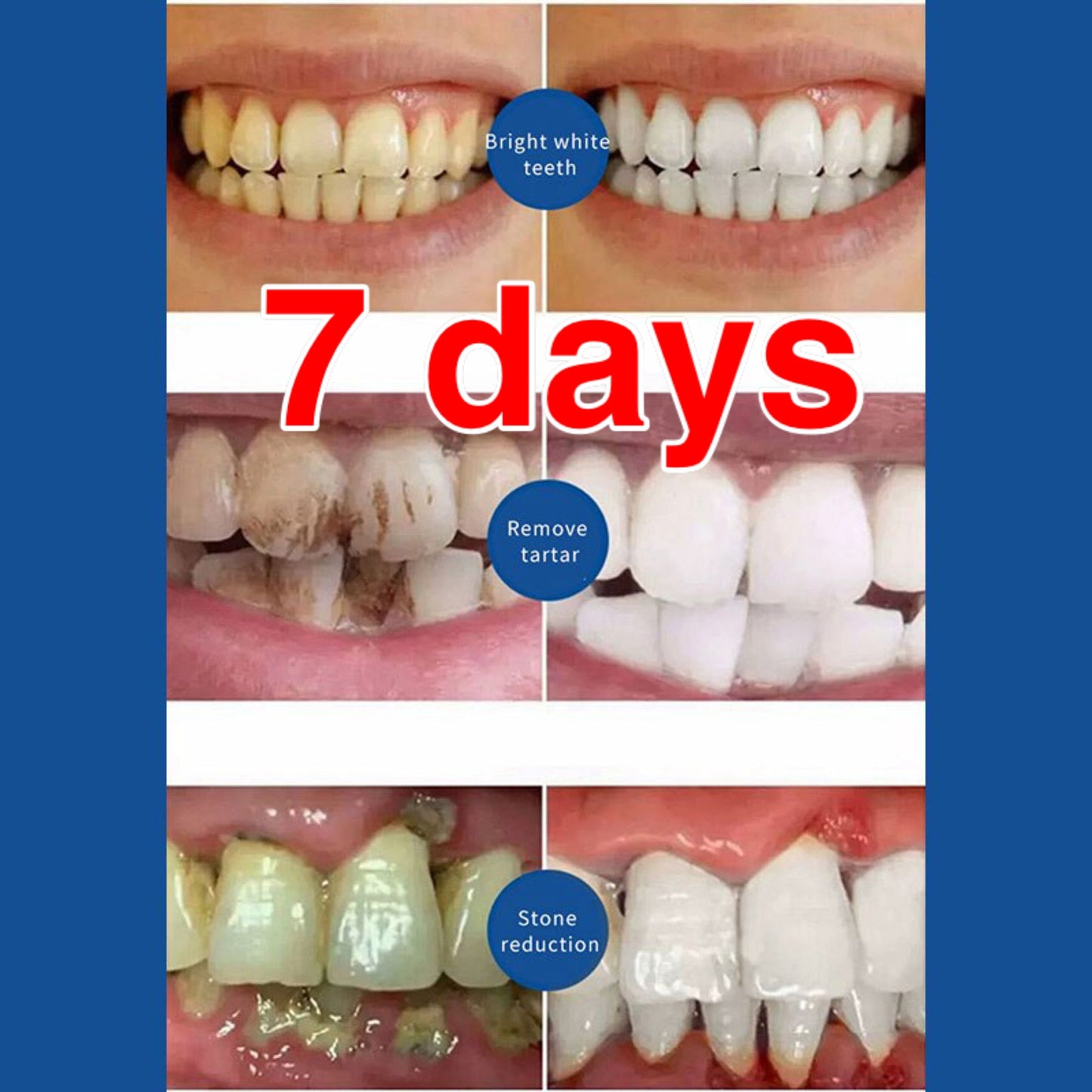 7  Days  Quick Repair of Cavities Caries Removal of Plaque Stains Decay Whitening Yellowing Repair Teeth Teeth Whitening